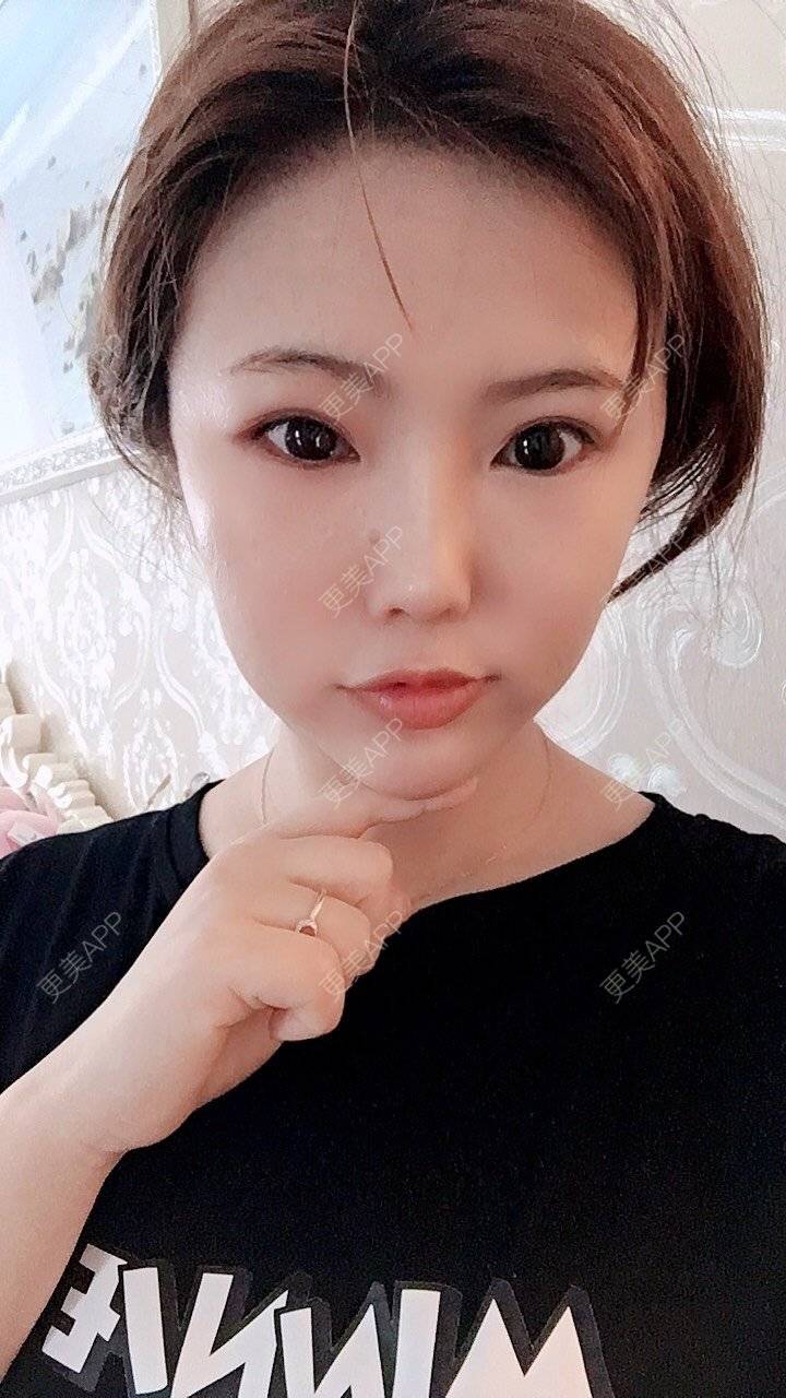 更美 - 家有宝兔的玻尿酸经验 | 玻尿酸套餐 | 上海 | 玻尿酸