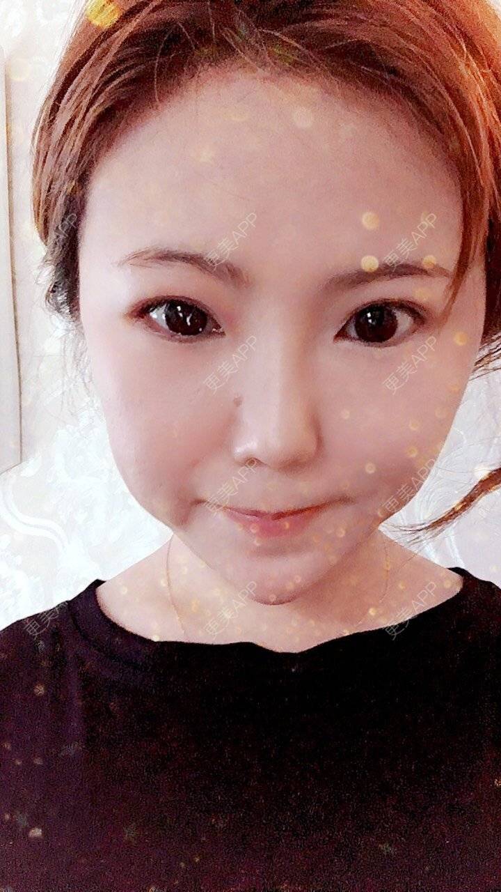 更美 - 家有宝兔的玻尿酸经验 | 玻尿酸套餐 | 上海 | 玻尿酸