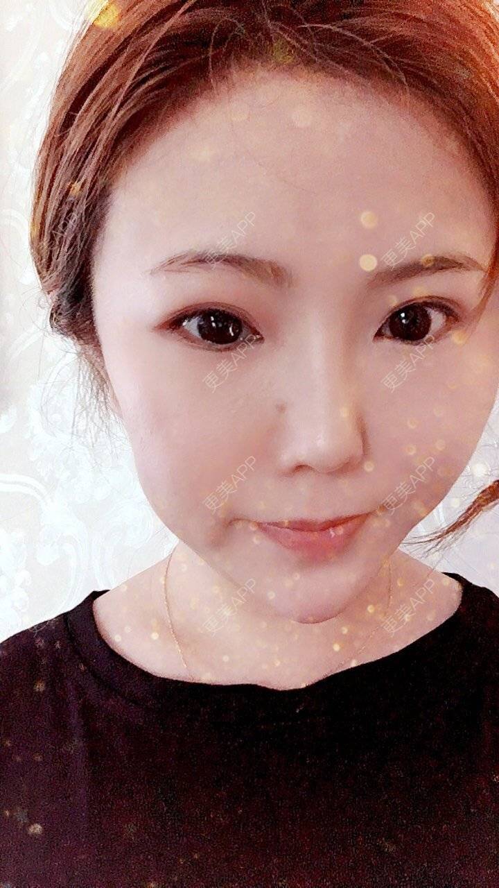 更美 - 家有宝兔的玻尿酸经验 | 玻尿酸套餐 | 上海 | 玻尿酸