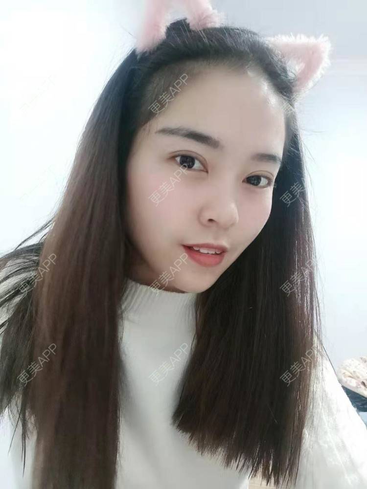 更美 - 更美用户uK1ce6rfue的全切双眼皮经验 | 眼部多项 | 广州