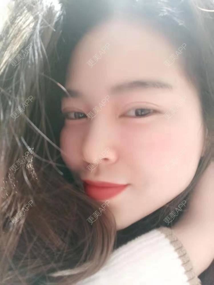 更美 - 更美用户uK1ce6rfue的全切双眼皮经验 | 眼部多项 | 广州