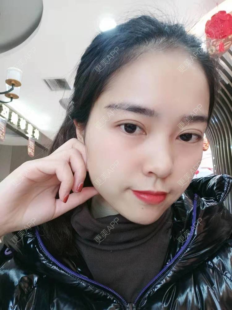 更美 - 更美用户uK1ce6rfue的全切双眼皮经验 | 眼部多项 | 广州