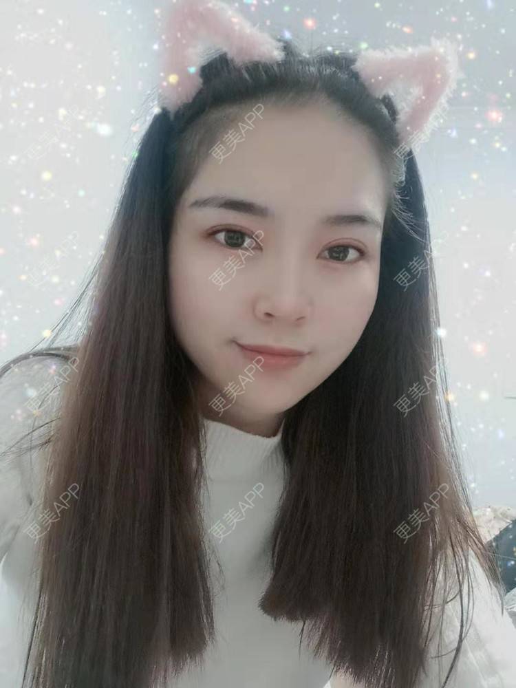 更美 - 更美用户uK1ce6rfue的全切双眼皮经验 | 眼部多项 | 广州