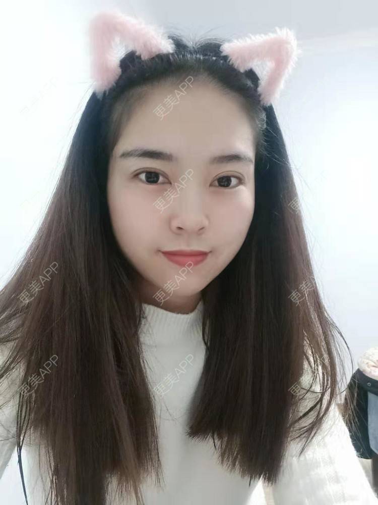 更美 - 更美用户uK1ce6rfue的全切双眼皮经验 | 眼部多项 | 广州