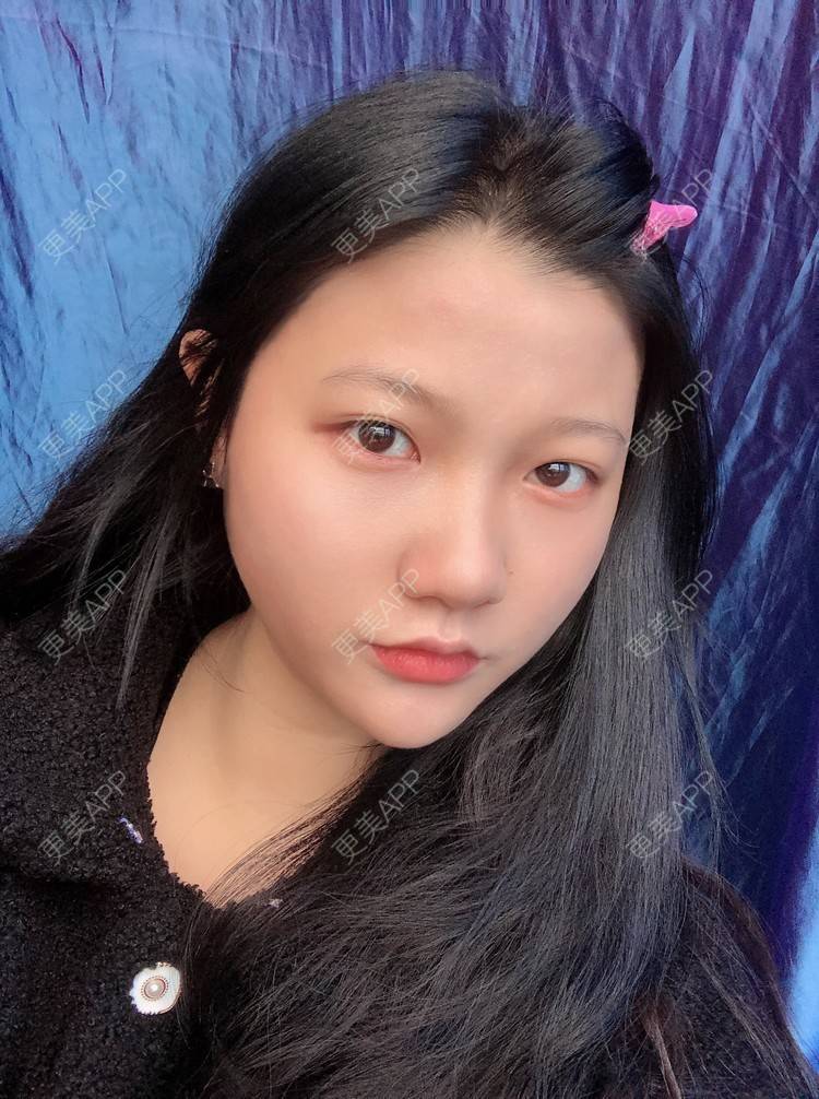 更美 - 男朋友是彭于晏的M唇成形经验 | M唇成形 | 杭州