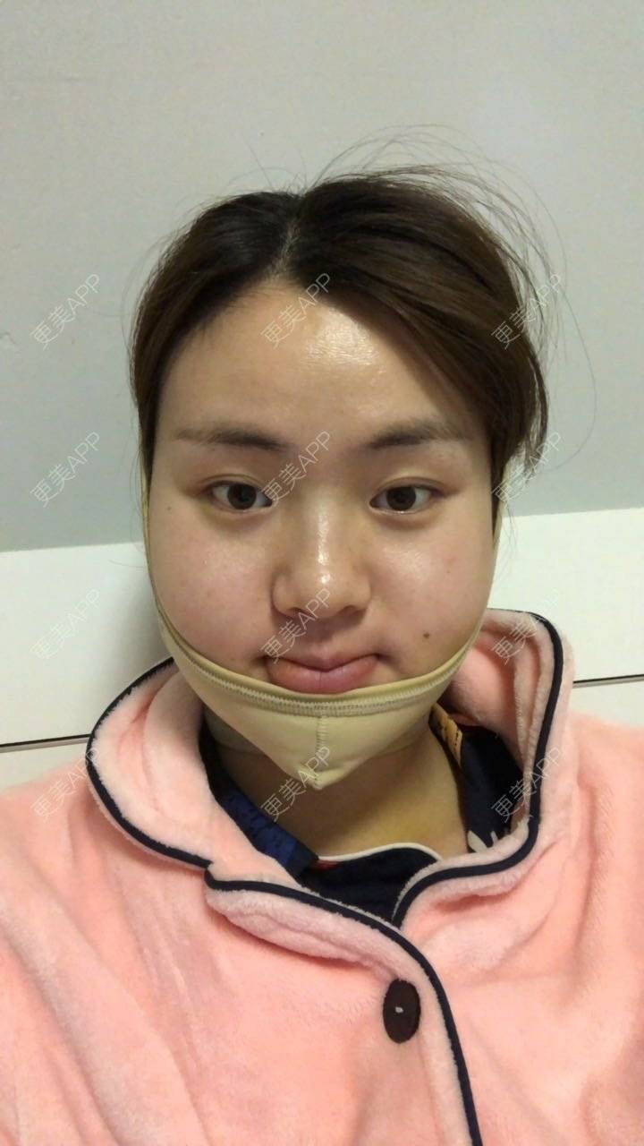 穿着帆布鞋扭猫步床的下颌角切除术日记