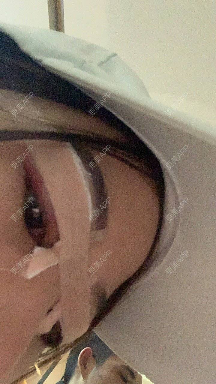更美 - 仙人.的全切双眼皮经验 | 全切双眼皮 | 深圳
