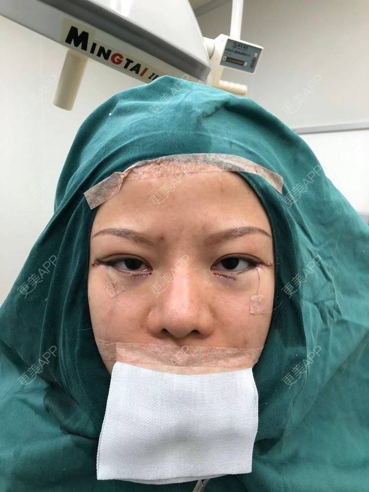 更美 - 更美用户cP7Wc5ySj9的开外眼角经验 | 开外眼角 | 开眼角修复 | 广州