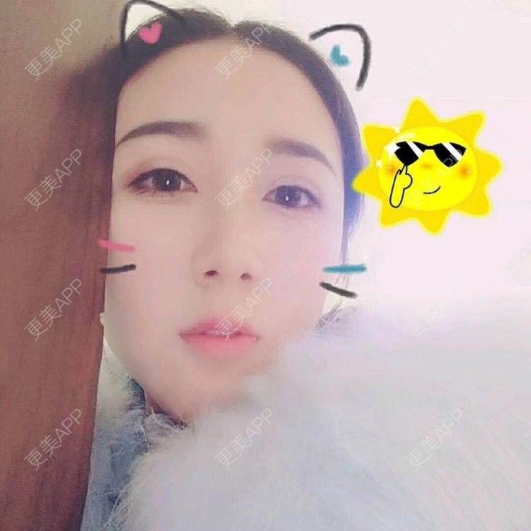 更美 - 阿玲铃的硅胶垫下巴经验 | 硅胶垫下巴 | 成都