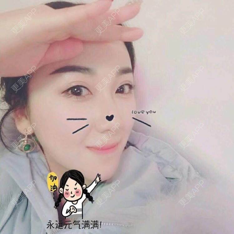 更美 - 阿玲铃的硅胶垫下巴经验 | 硅胶垫下巴 | 成都