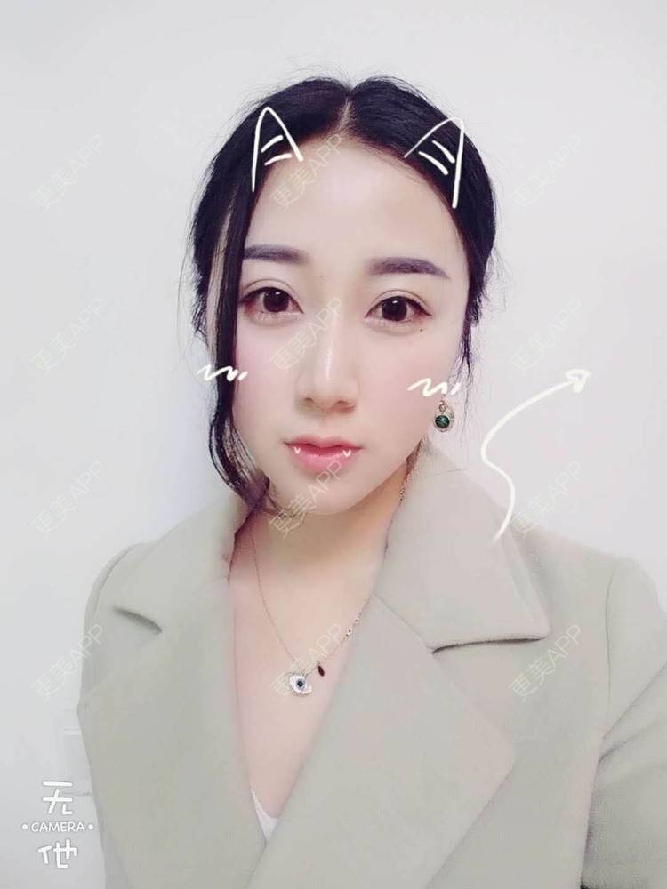 更美 - 阿玲铃的硅胶垫下巴经验 | 硅胶垫下巴 | 成都