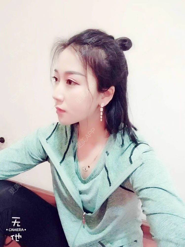更美 - 阿玲铃的硅胶垫下巴经验 | 硅胶垫下巴 | 成都