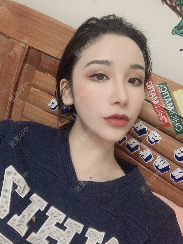更美 - 岁月无忧愁的自体脂肪全面部填充经验 | 自体脂肪丰面颊 | 自体脂肪填充泪沟 | 自体脂肪丰苹果肌 | 自体脂肪隆鼻 | 自体脂肪垫下巴 | 自体脂肪丰太阳穴 | 自体脂肪丰额头 | 自体脂肪垫眉弓 | 自体脂肪全面部填充