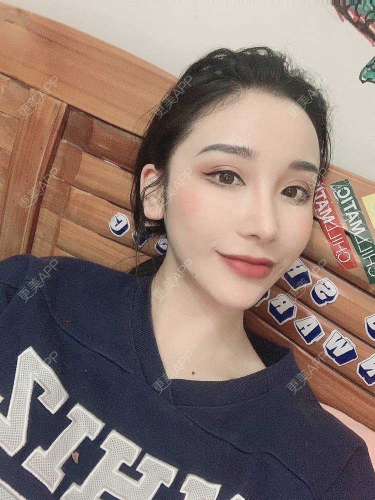 更美 - 岁月无忧愁的自体脂肪全面部填充经验 | 自体脂肪丰面颊 | 自体脂肪填充泪沟 | 自体脂肪丰苹果肌 | 自体脂肪隆鼻 | 自体脂肪垫下巴 | 自体脂肪丰太阳穴 | 自体脂肪丰额头 | 自体脂肪垫眉弓 | 自体脂肪全面部填充