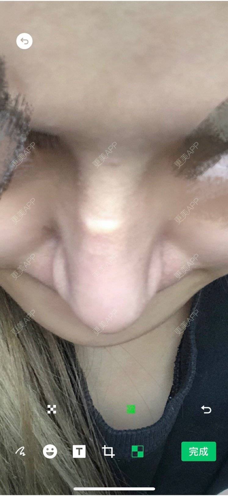 更美 - 更美用户1ywSBSzzuO的肋软骨隆鼻经验 | 肋软骨隆鼻 | 杭州