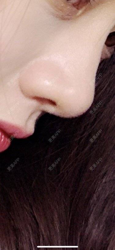 更美 - 更美用户1ywSBSzzuO的肋软骨隆鼻经验 | 肋软骨隆鼻 | 杭州