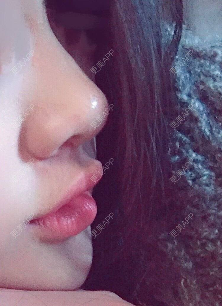 更美 - 更美用户1ywSBSzzuO的肋软骨隆鼻经验 | 肋软骨隆鼻 | 杭州