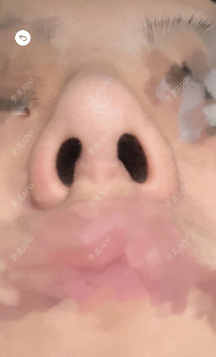 更美 - 更美用户1ywSBSzzuO的肋软骨隆鼻经验 | 肋软骨隆鼻 | 杭州