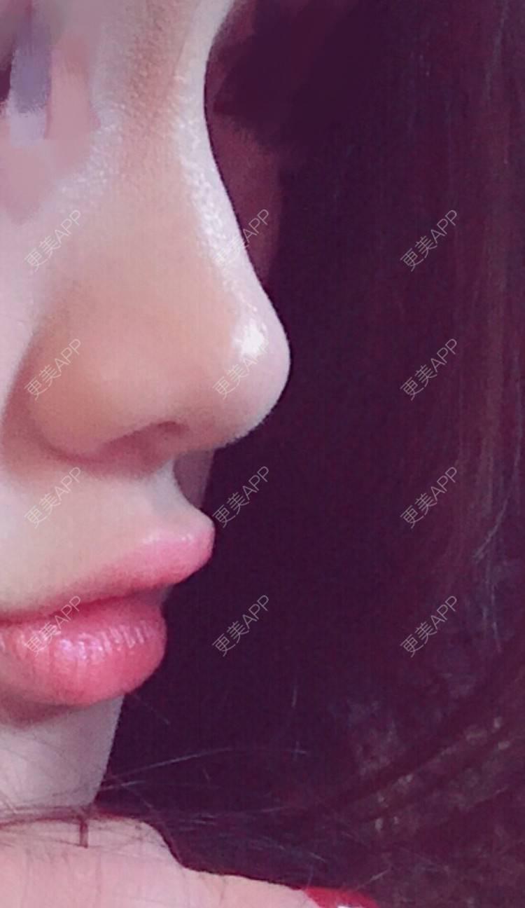 更美 - 更美用户1ywSBSzzuO的肋软骨隆鼻经验 | 肋软骨隆鼻 | 杭州