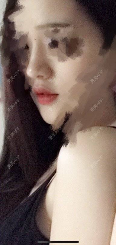 更美 - 更美用户1ywSBSzzuO的肋软骨隆鼻经验 | 肋软骨隆鼻 | 杭州