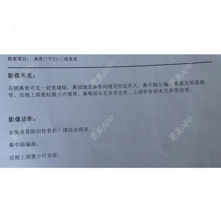 更美 - 更美用户1ywSBSzzuO的肋软骨隆鼻经验 | 肋软骨隆鼻 | 杭州