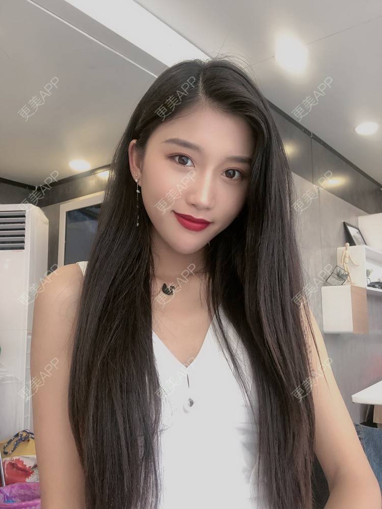 更美 - 木子木可的M唇成形经验 | M唇成形 | 杭州