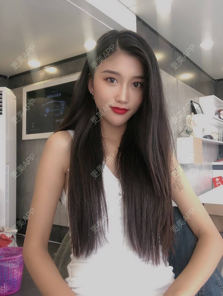 更美 - 木子木可的M唇成形经验 | M唇成形 | 杭州