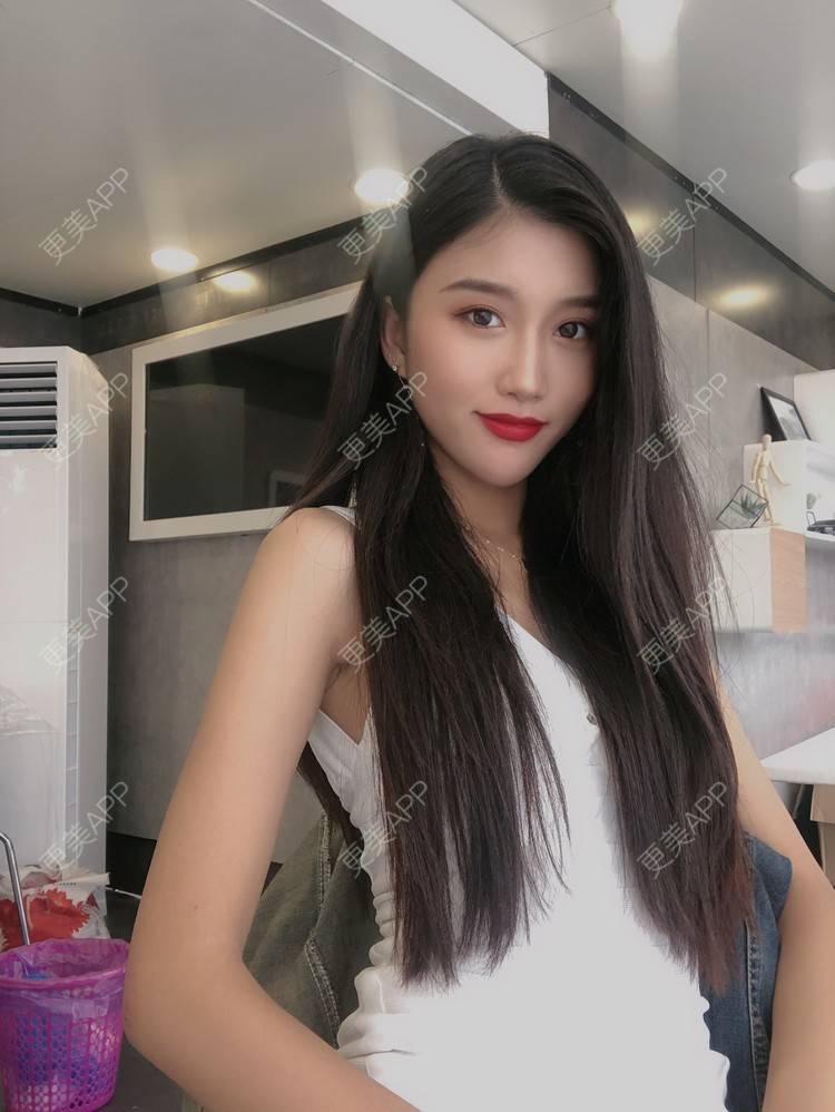 更美 - 木子木可的M唇成形经验 | M唇成形 | 杭州