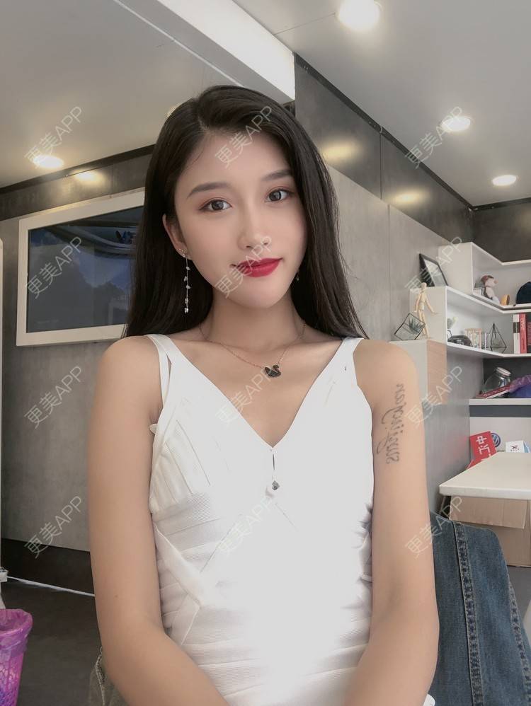 更美 - 木子木可的M唇成形经验 | M唇成形 | 杭州