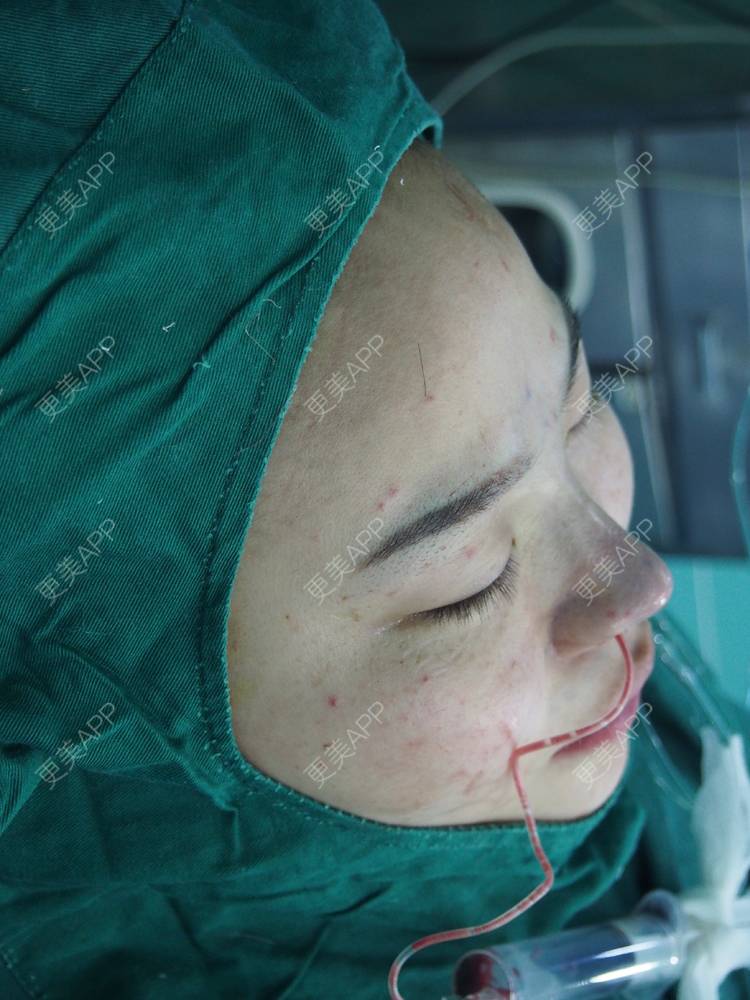 缩小】【公立同济】鼻翼肥大蒜头鼻·鼻孔塑形内侧切口武汉￥4630起