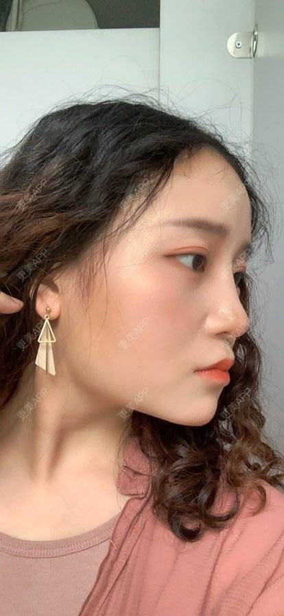更美 - 圆方脸课代表ʚ😊ɞ的隆鼻经验 | 隆鼻 | 耳软骨隆鼻 | 假体垫鼻基底 | 鼻部多项 | 全切双眼皮 | 自体软骨垫鼻尖 | 硅胶隆鼻 | 南京 | 视频日记