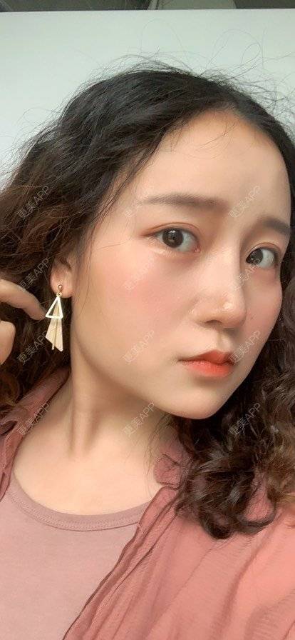 更美 - 圆方脸课代表ʚ😊ɞ的隆鼻经验 | 隆鼻 | 耳软骨隆鼻 | 假体垫鼻基底 | 鼻部多项 | 全切双眼皮 | 自体软骨垫鼻尖 | 硅胶隆鼻 | 南京 | 视频日记