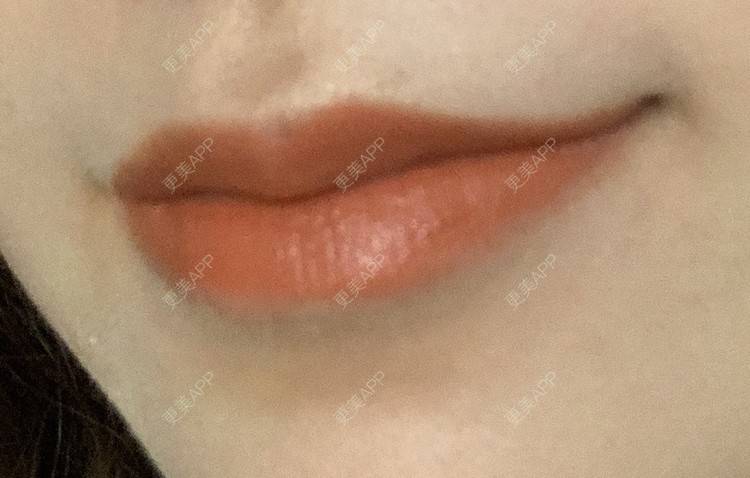 更美 - 圆方脸课代表ʚ😊ɞ的隆鼻经验 | 隆鼻 | 耳软骨隆鼻 | 假体垫鼻基底 | 鼻部多项 | 全切双眼皮 | 自体软骨垫鼻尖 | 硅胶隆鼻 | 南京 | 视频日记