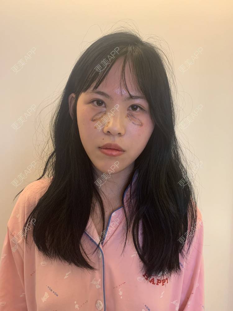 更美 - 琳琳琳琳琳啊的自体脂肪丰卧蚕经验 | 自体脂肪丰卧蚕