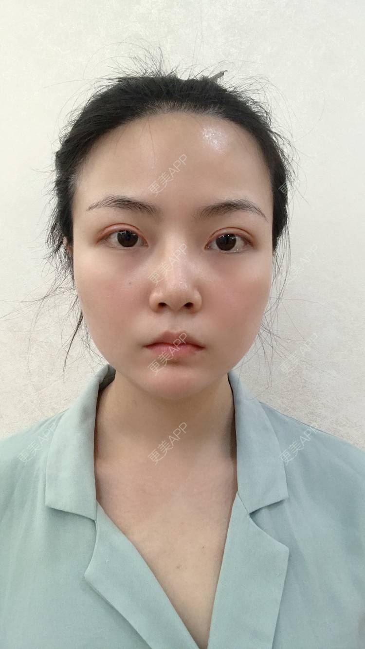 更美 - 虫栗的双眼皮经验 | 双眼皮 | 北京