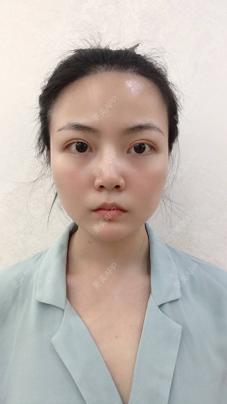 更美 - 虫栗的双眼皮经验 | 双眼皮 | 北京