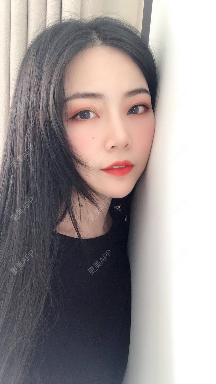 更美 - 虫栗的双眼皮经验 | 双眼皮 | 北京