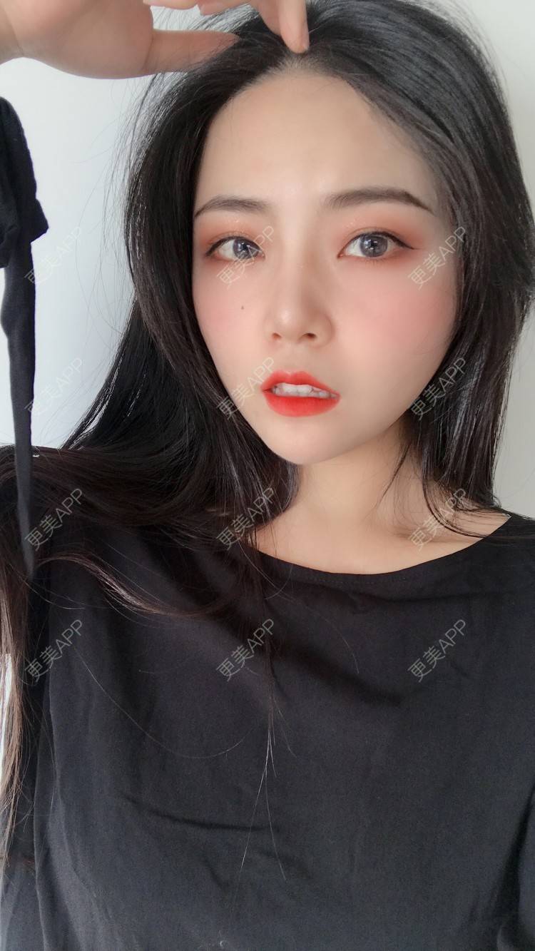 更美 - 虫栗的双眼皮经验 | 双眼皮 | 北京