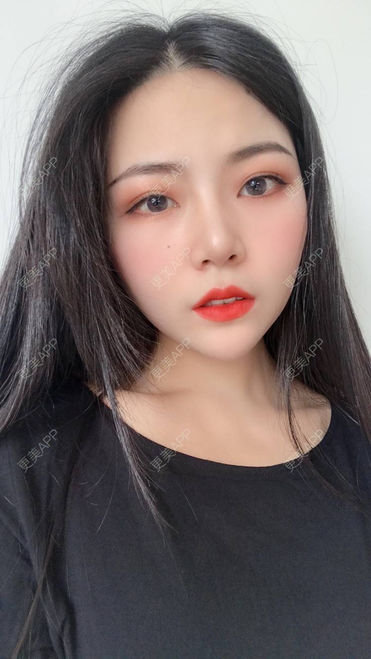 更美 - 虫栗的双眼皮经验 | 双眼皮 | 北京