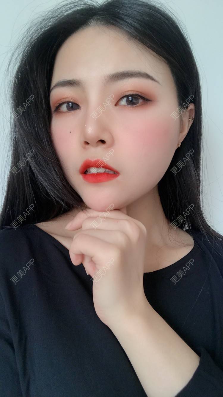 更美 - 虫栗的双眼皮经验 | 双眼皮 | 北京