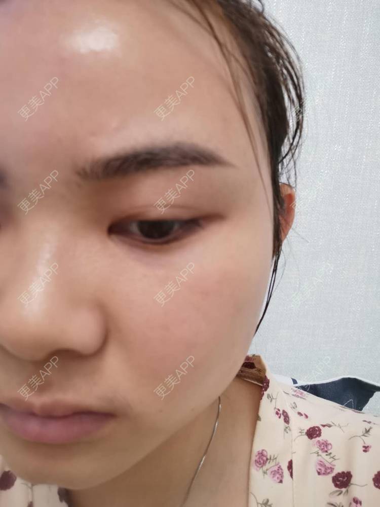 更美 - 不一“斑”的人的激光淡化红血丝经验 | 激光淡斑 | 皮秒激光 | 淡斑套餐 | 祛斑祛色素 | 化学剥脱淡斑