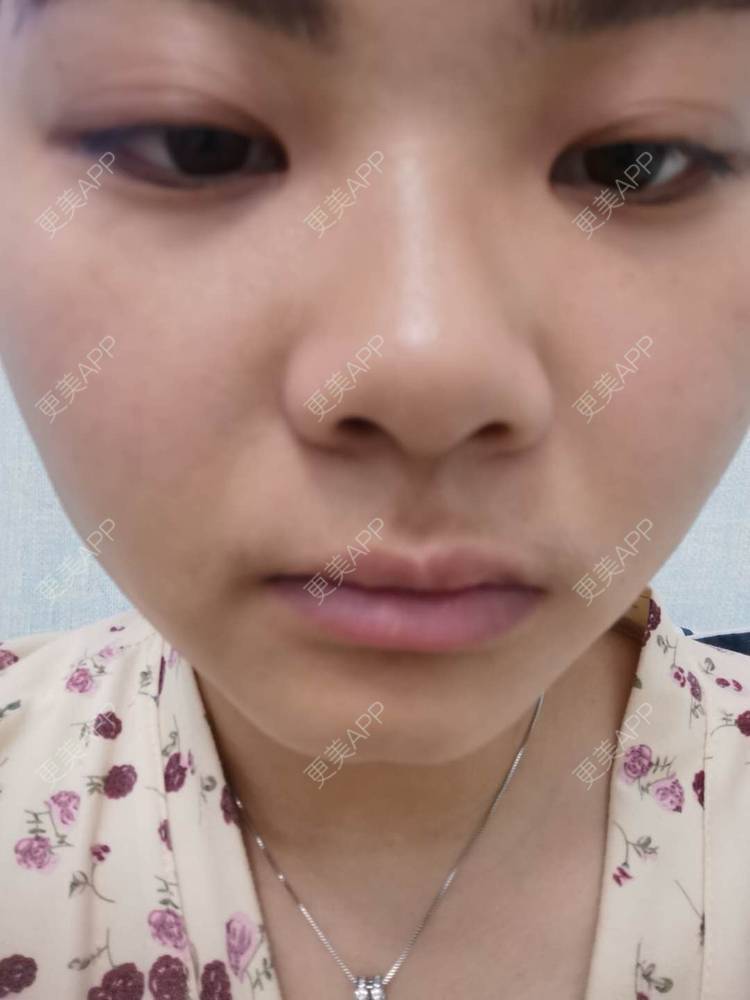 更美 - 不一“斑”的人的激光淡化红血丝经验 | 激光淡斑 | 皮秒激光 | 淡斑套餐 | 祛斑祛色素 | 化学剥脱淡斑