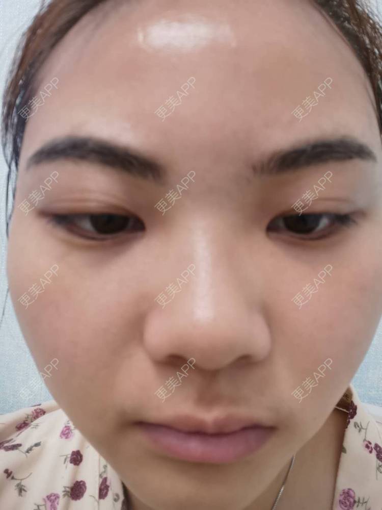 更美 - 不一“斑”的人的激光淡化红血丝经验 | 激光淡斑 | 皮秒激光 | 淡斑套餐 | 祛斑祛色素 | 化学剥脱淡斑