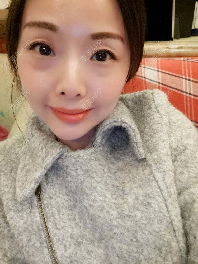 更美 - 千鲤倬的自体脂肪垫下巴经验 | 自体脂肪垫下巴 | 广州