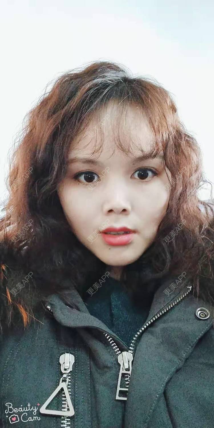 更美 - 更美用户VzYLHjPH4B的拉皮经验 | 郑州 | 拉皮