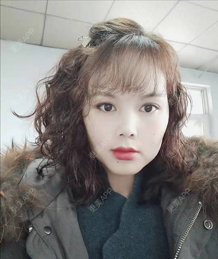 更美 - 更美用户VzYLHjPH4B的拉皮经验 | 郑州 | 拉皮