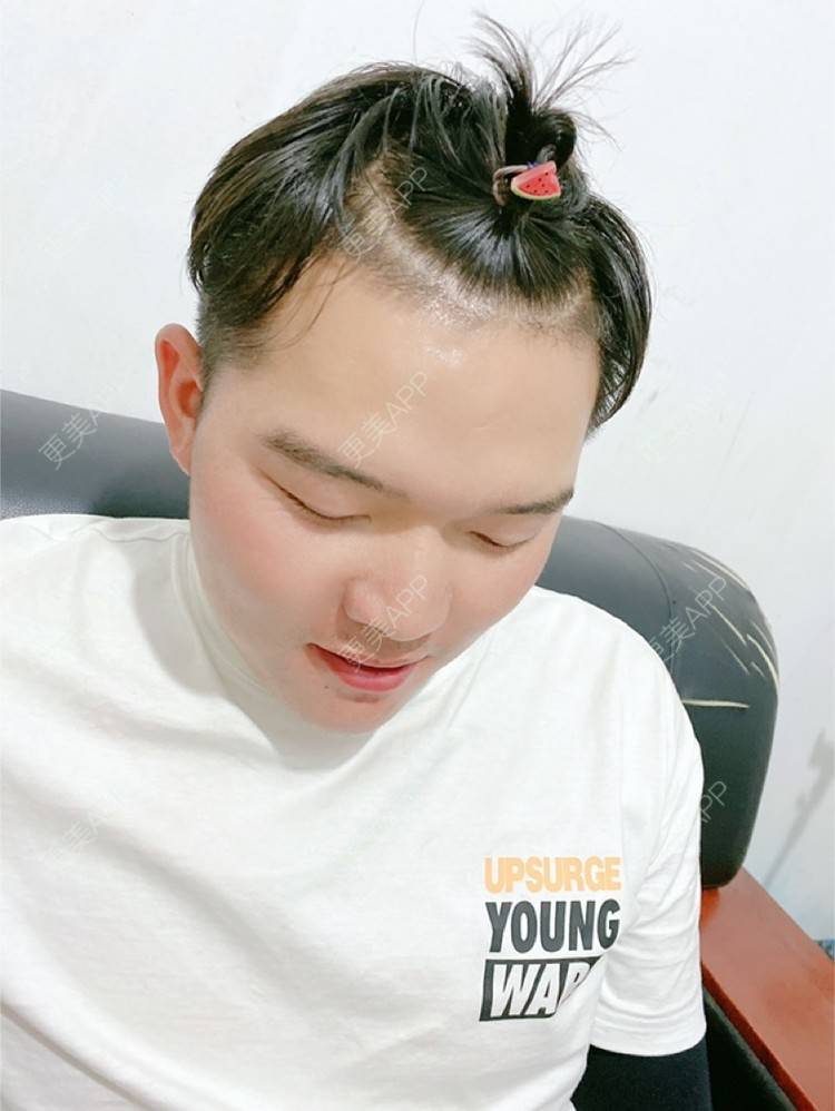 更美 - Amnot的自体脂肪丰面颊经验 | 自体脂肪丰面颊 | 自体脂肪丰太阳穴 | 重庆