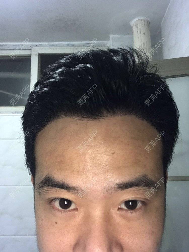 更美 - 更美用户bczzhkcnjm的鬓角植发日记 | 植发际线 | 毛发移植