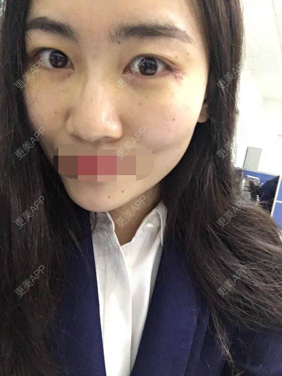 更美 - 一帘幽梦w的外切去眼袋经验 | 成都 | 外切去眼袋