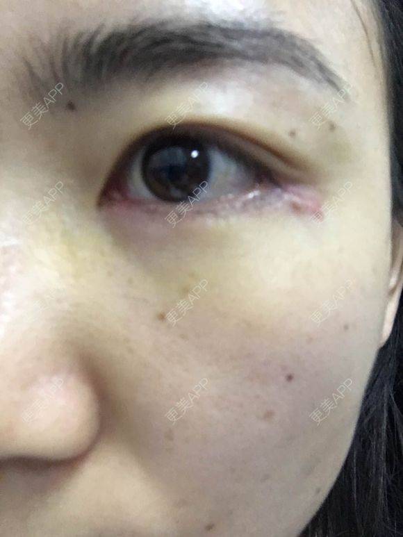 更美 - 一帘幽梦w的外切去眼袋经验 | 成都 | 外切去眼袋